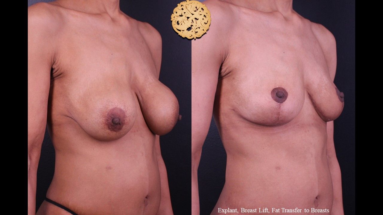 Nipple Reduction Before & After