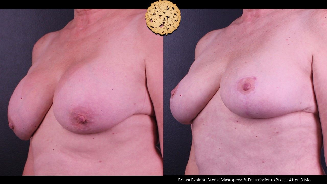 Nipple Reduction Before & After