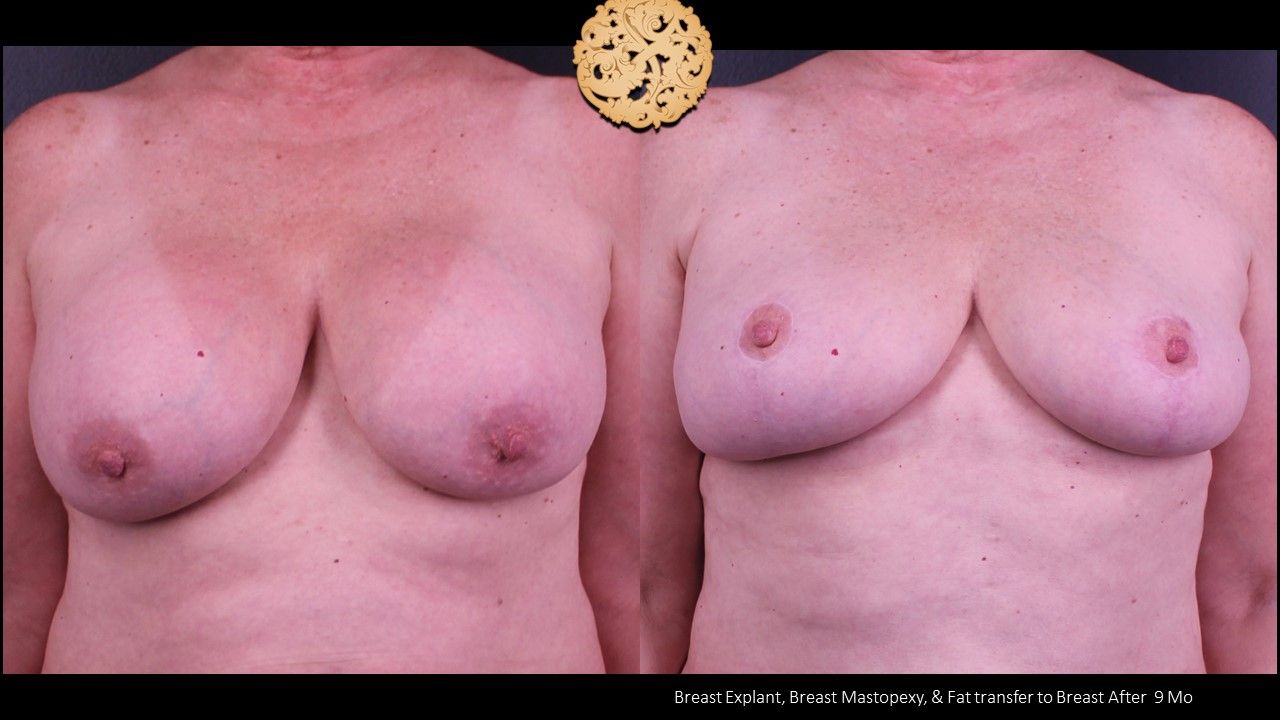 Nipple Reduction Before & After