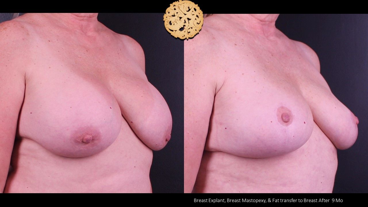 Nipple Reduction Before & After