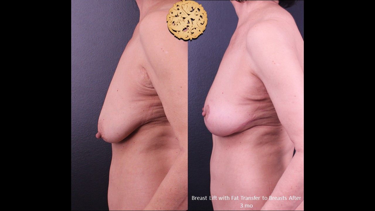 Nipple Reduction Before & After