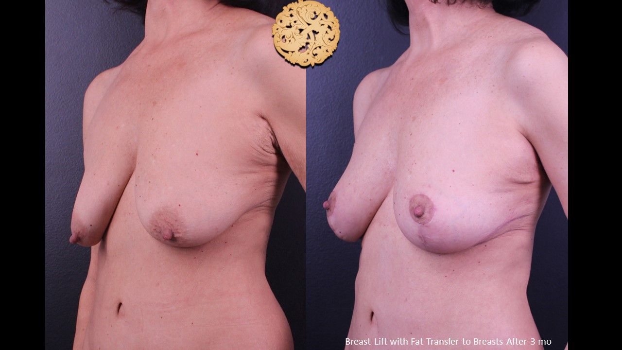 Nipple Reduction Before & After