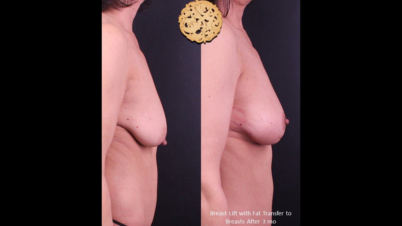 Nipple Reduction Before & After