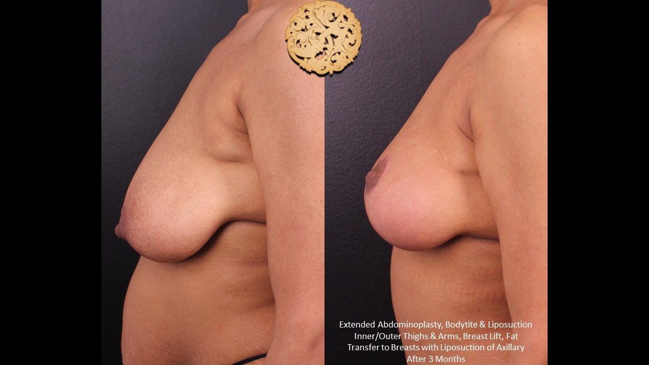 Nipple Reduction Before & After