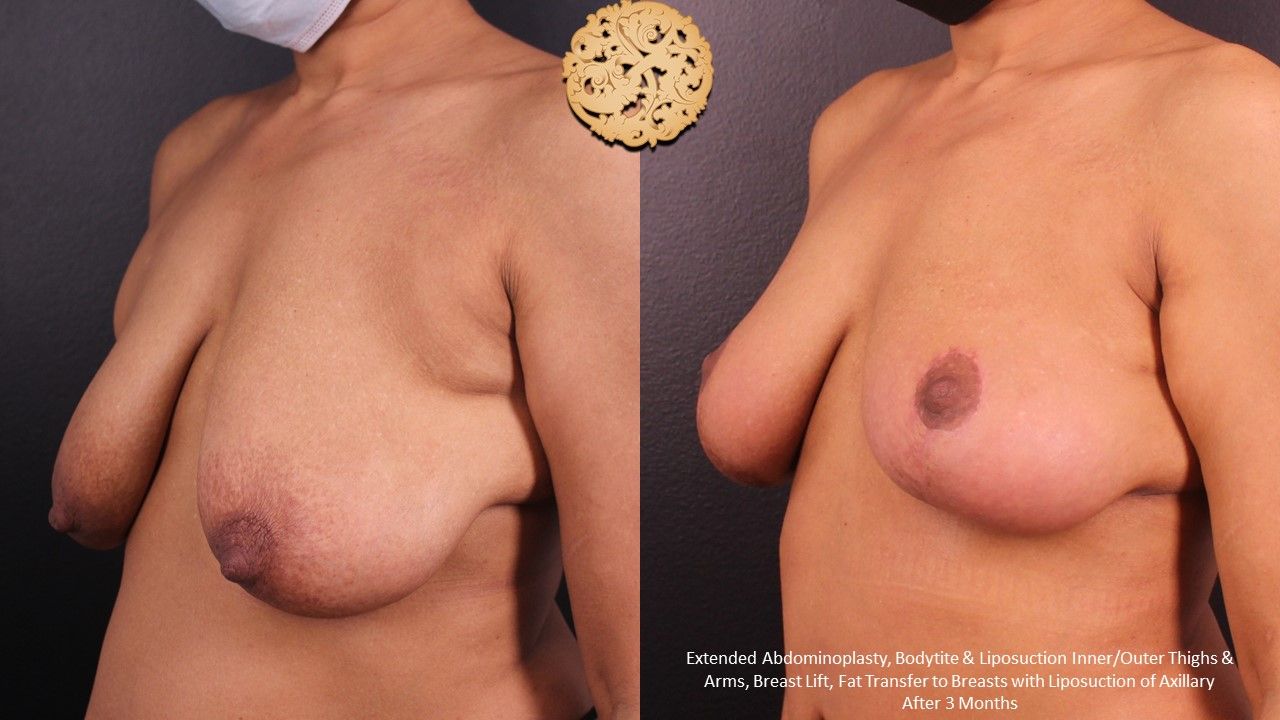 Nipple Reduction Before & After