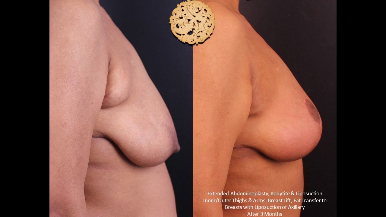 Nipple Reduction Before & After