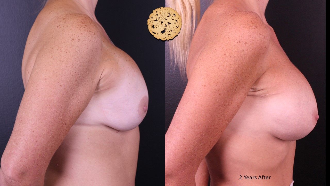 Nipple Reduction Before & After