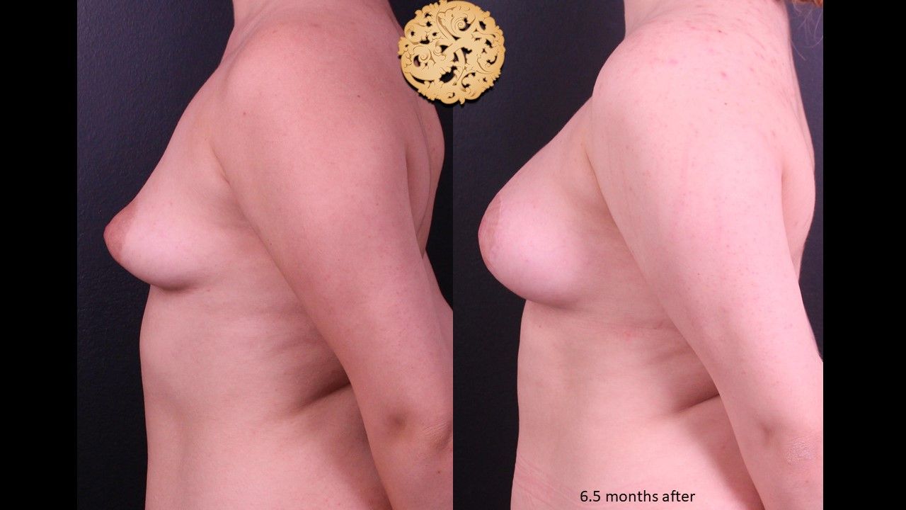Nipple Reduction Before & After