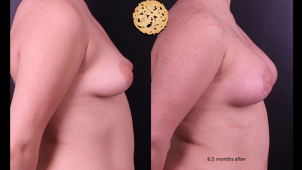 Nipple Reduction Before & After