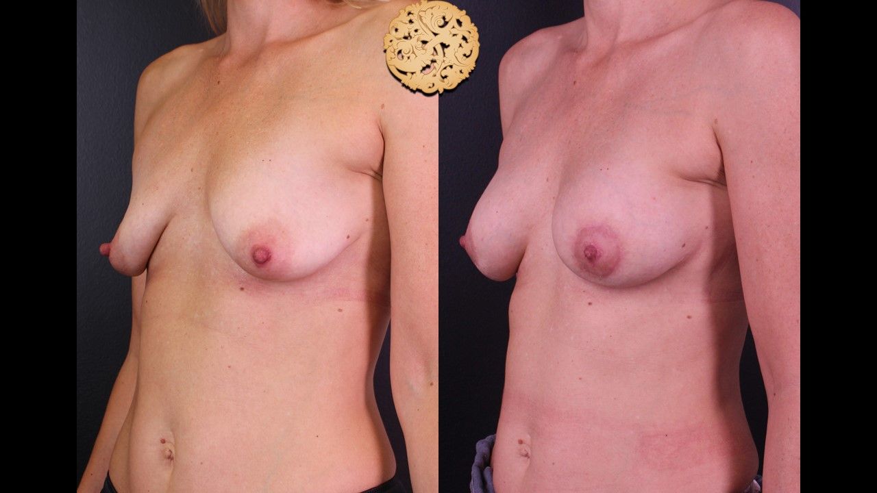 Nipple Reduction Before & After