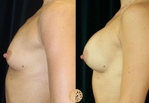 Nipple Reduction Before & After