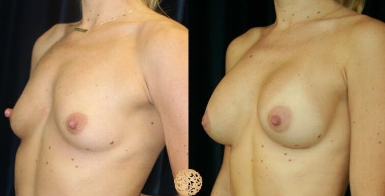 Nipple Reduction Before & After