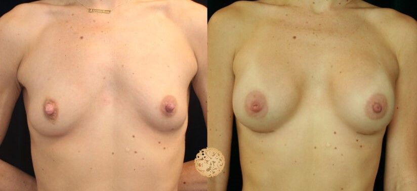 Nipple Reduction Before & After