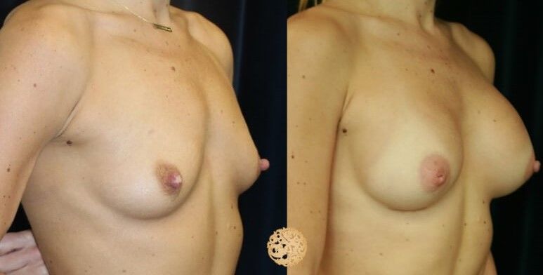 Nipple Reduction Before & After