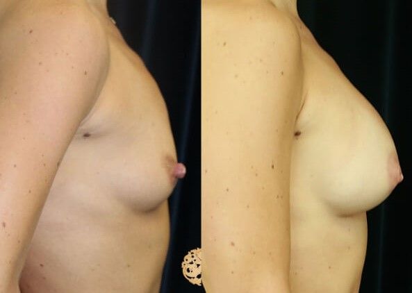 Nipple Reduction Before & After
