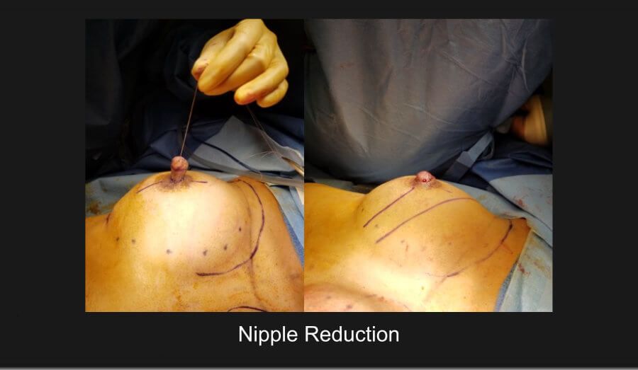 Nipple Reduction Before & After