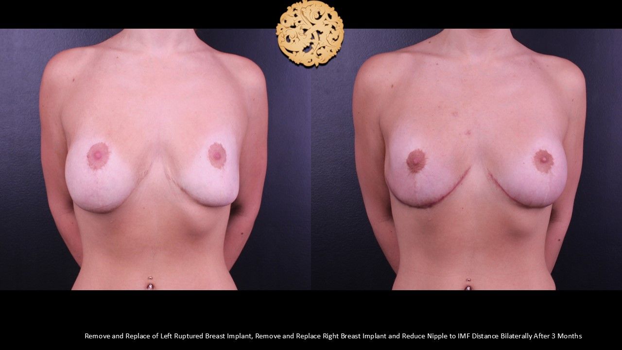 Nipple Reduction Before & After
