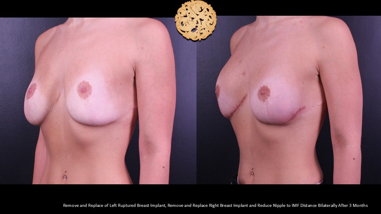 Nipple Reduction Before & After