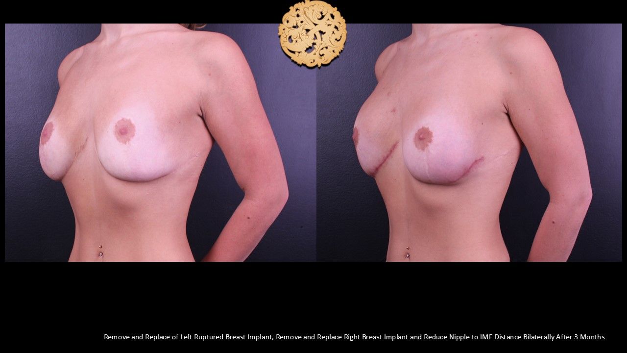 Nipple Reduction Before & After