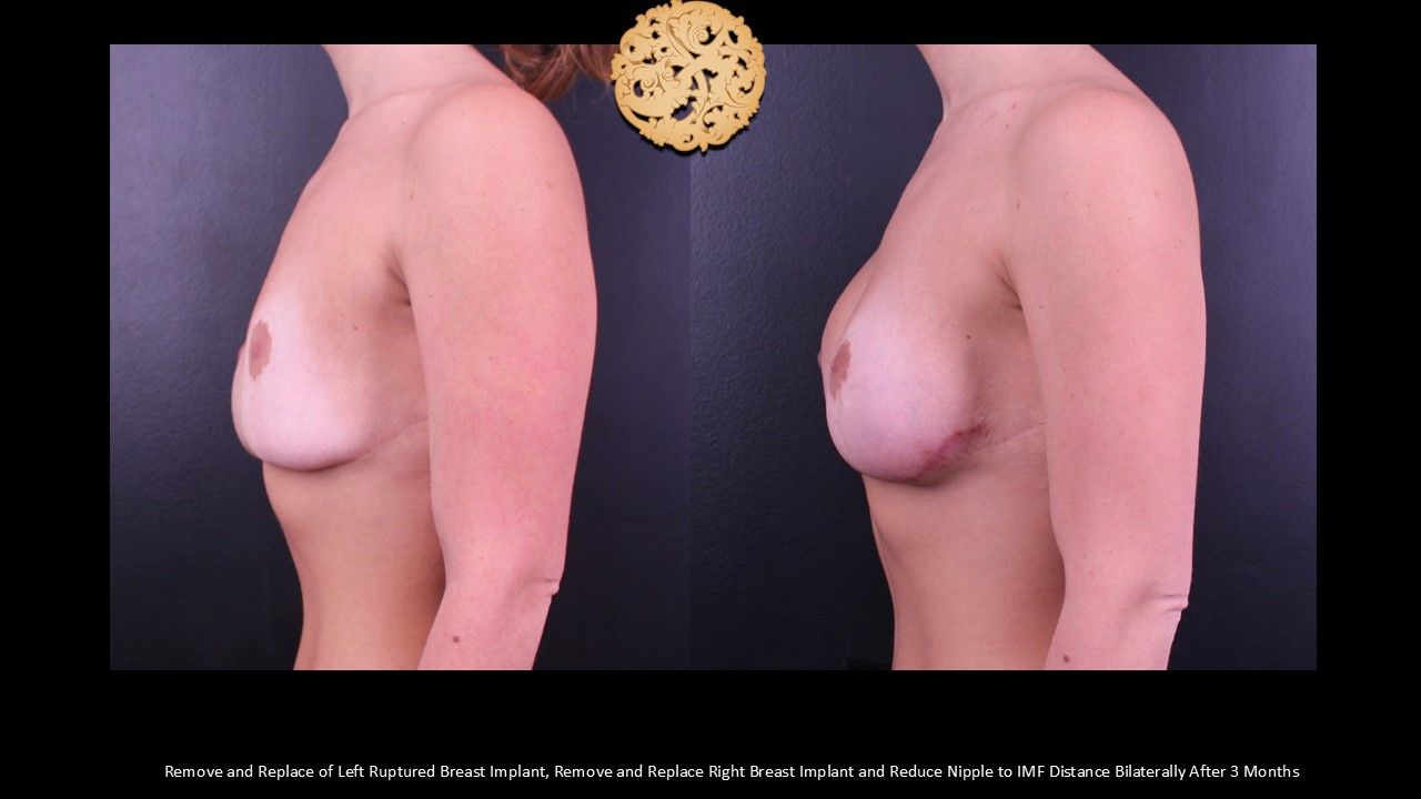 Nipple Reduction Before & After