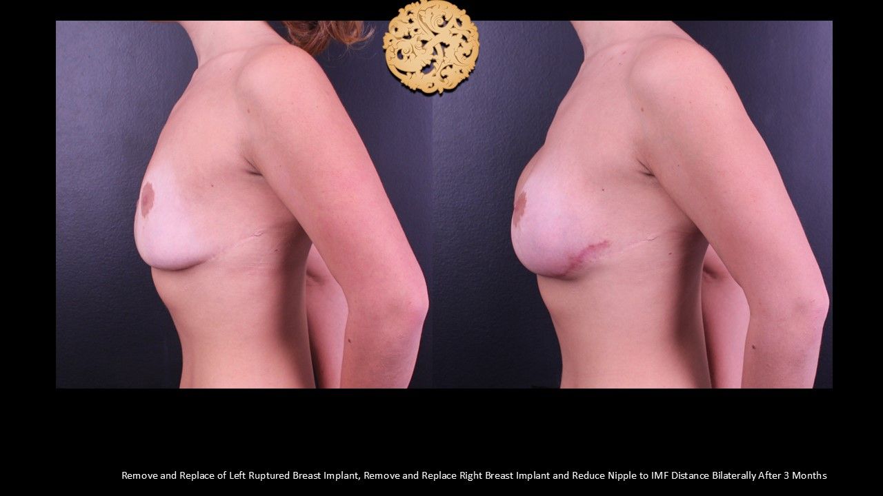 Nipple Reduction Before & After