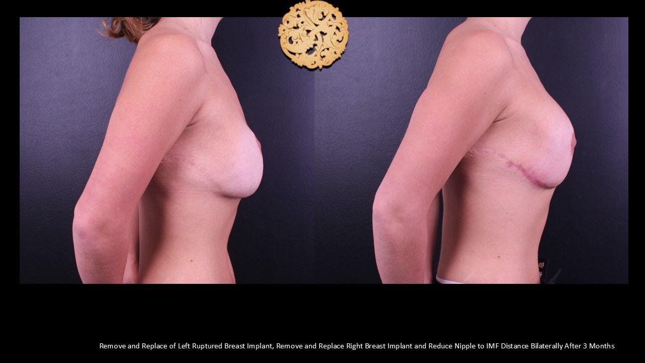 Nipple Reduction Before & After