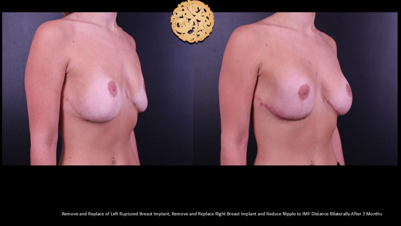Nipple Reduction Before & After