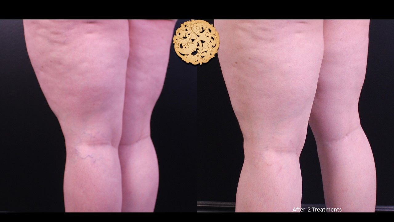 Excel V Before & After