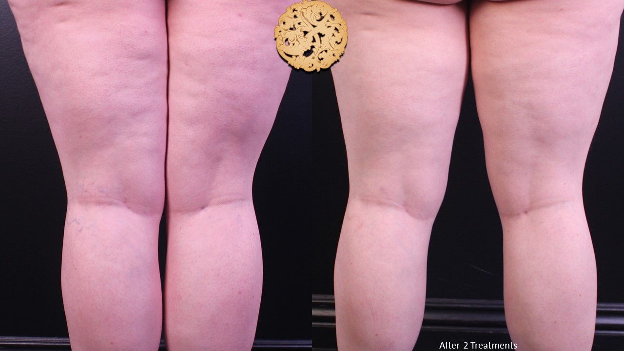 Excel V Before & After