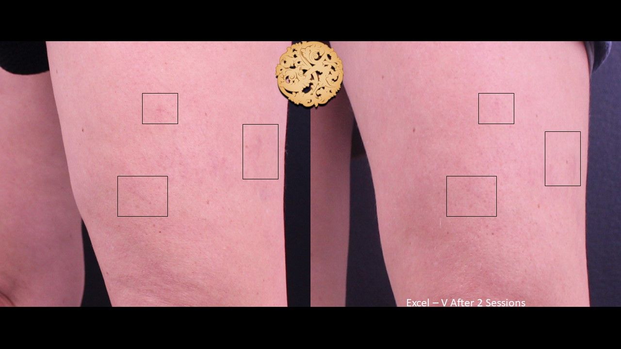 Excel V Before & After