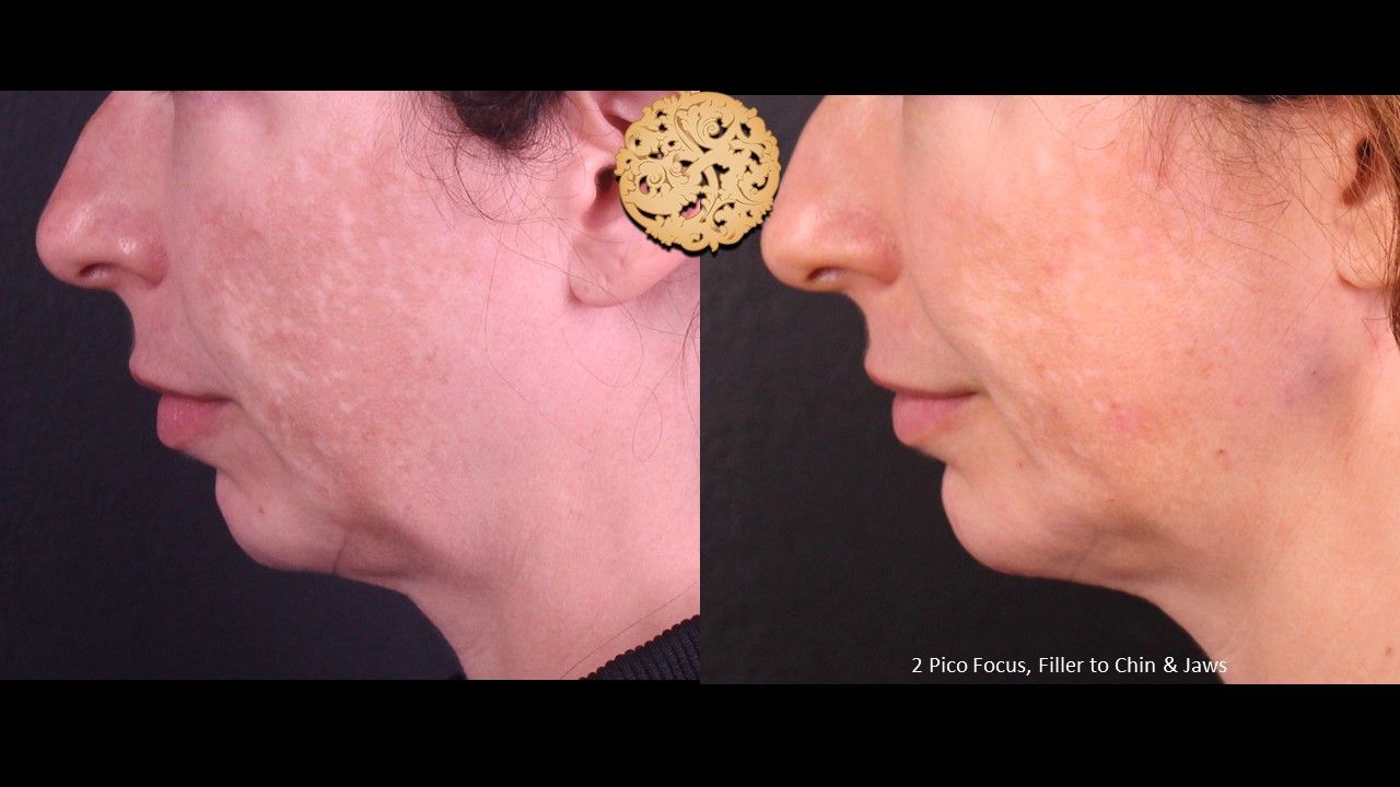 Picofocus Before & After