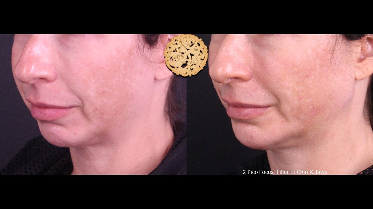 Picofocus Before & After