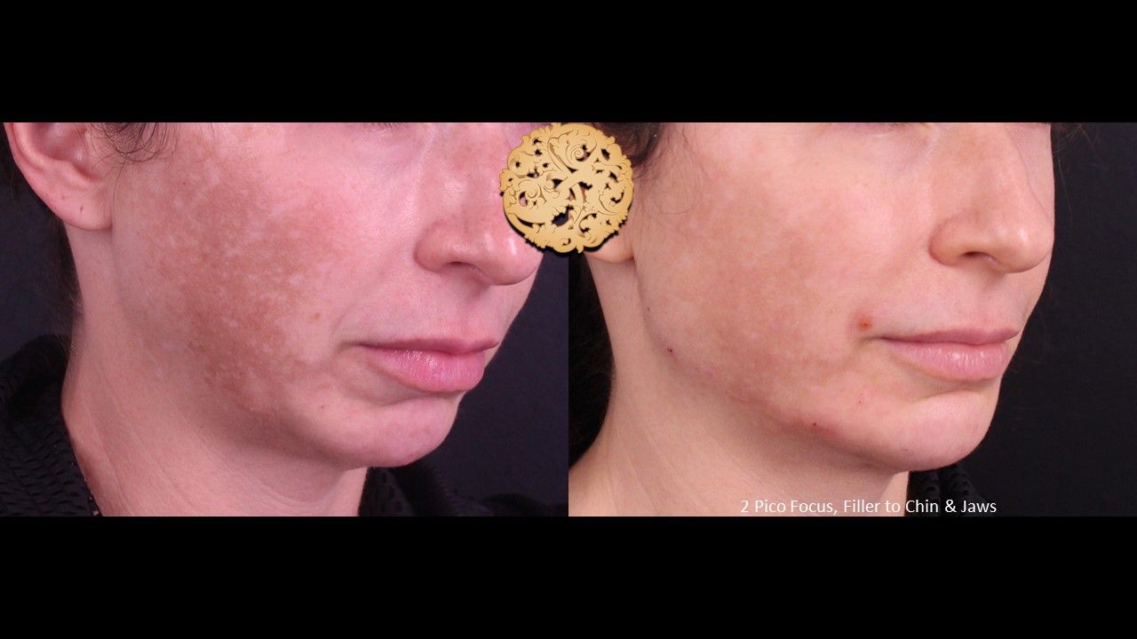 Picofocus Before & After