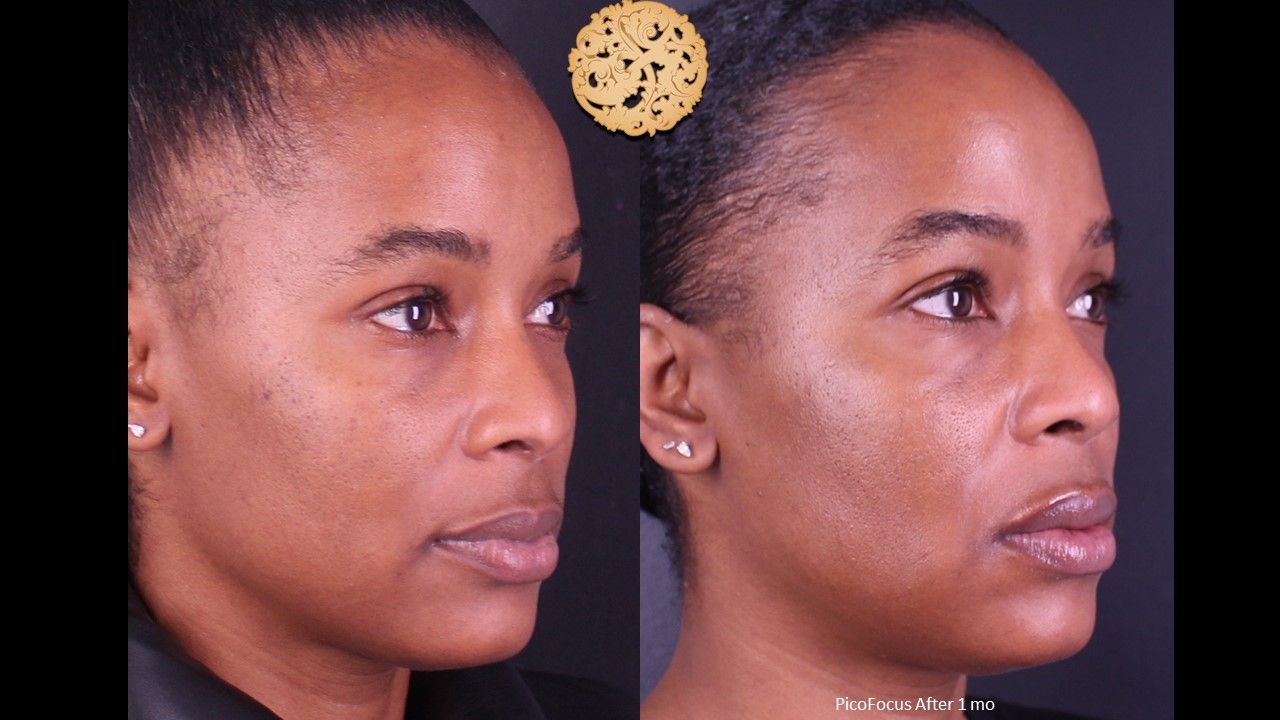 Picofocus Before & After