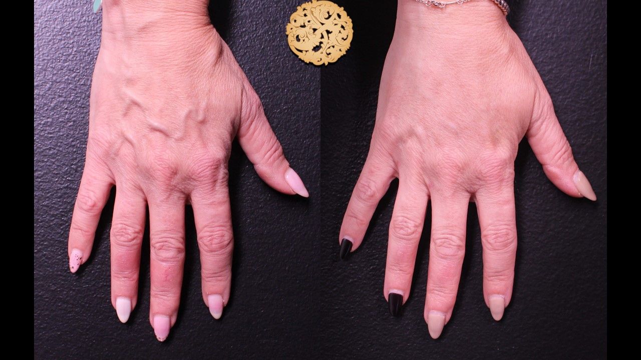 Fat Transfer Hands Before & After