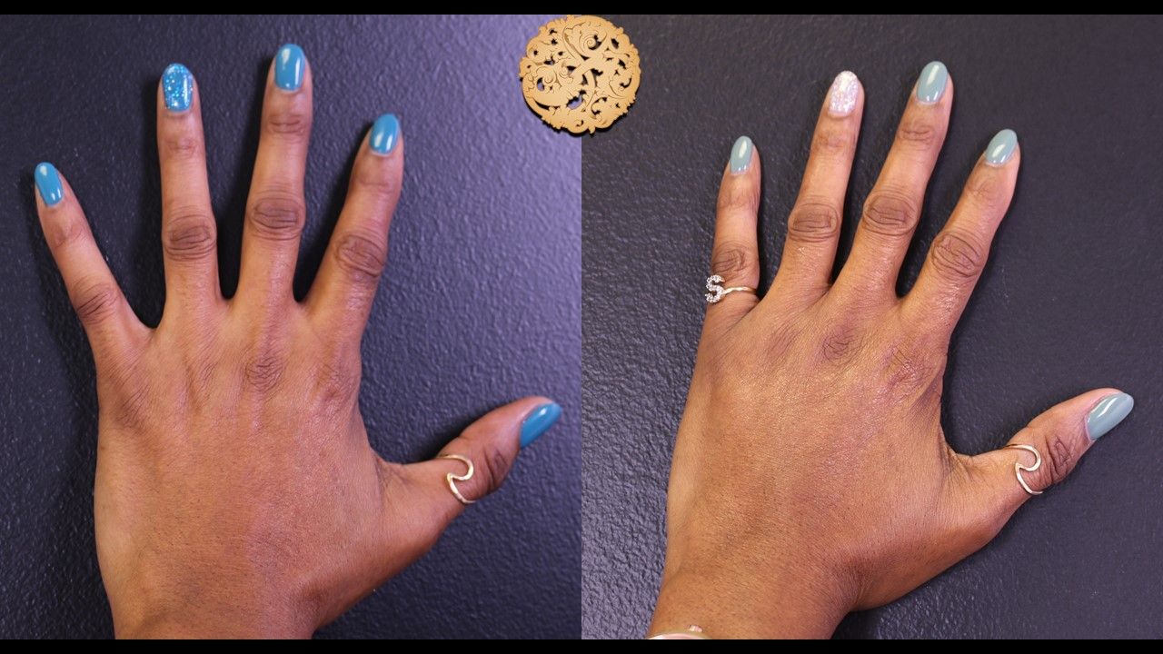 Fat Transfer Hands Before & After