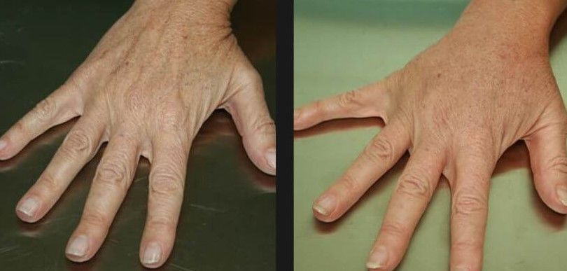 Fat Transfer Hands Before & After