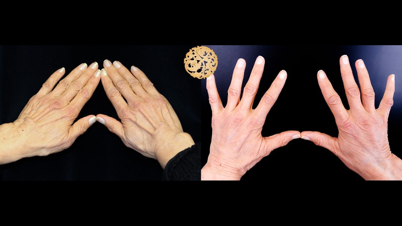 Fat Transfer Hands Before & After