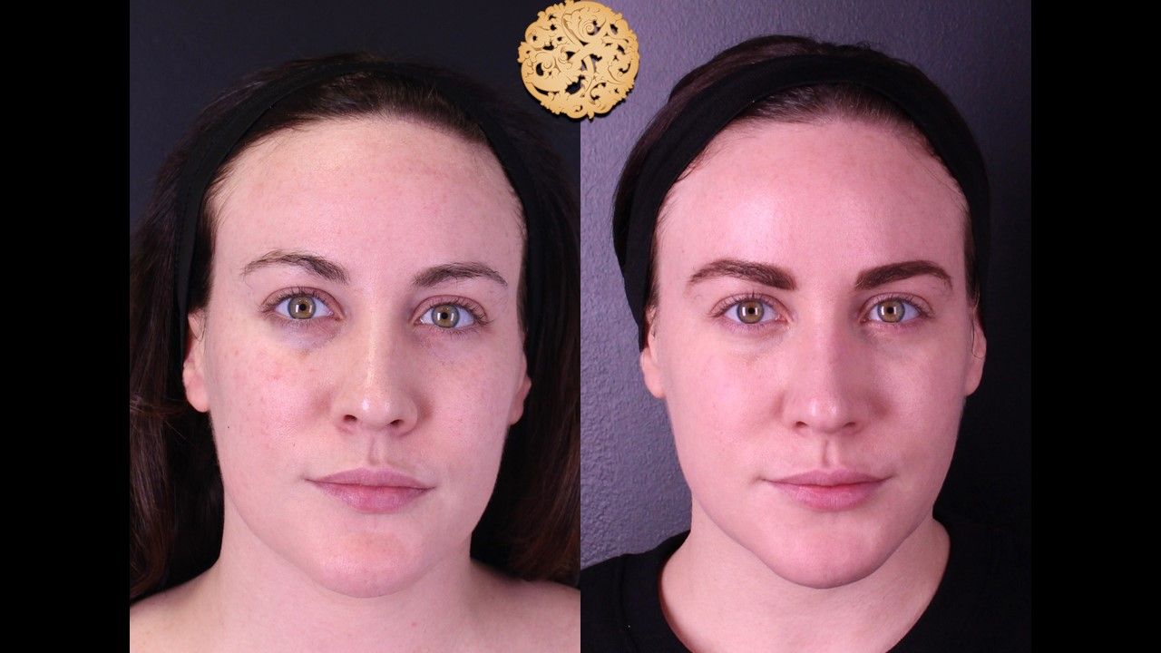 Gold Tip Botox Facial Before & After