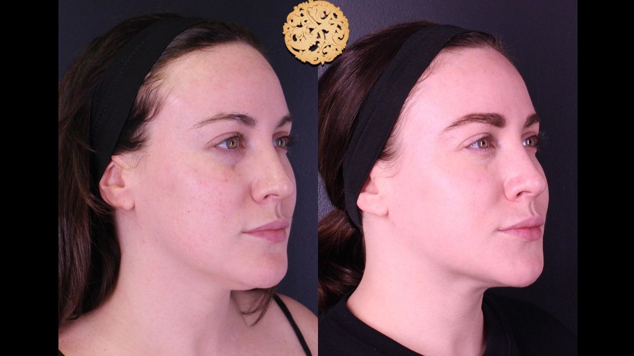 Gold Tip Botox Facial Before & After