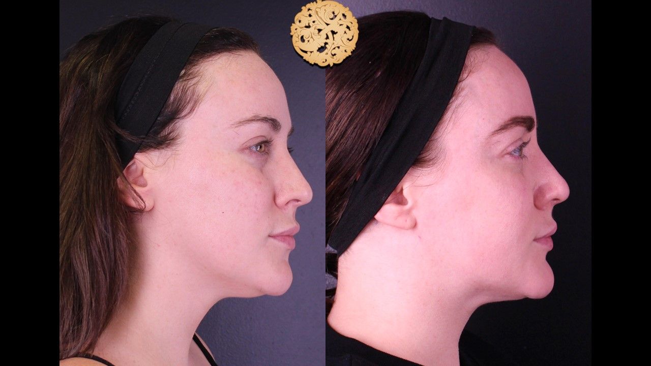 Gold Tip Botox Facial Before & After