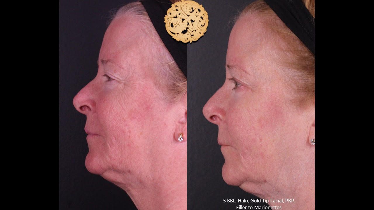 Gold Tip Botox Facial Before & After