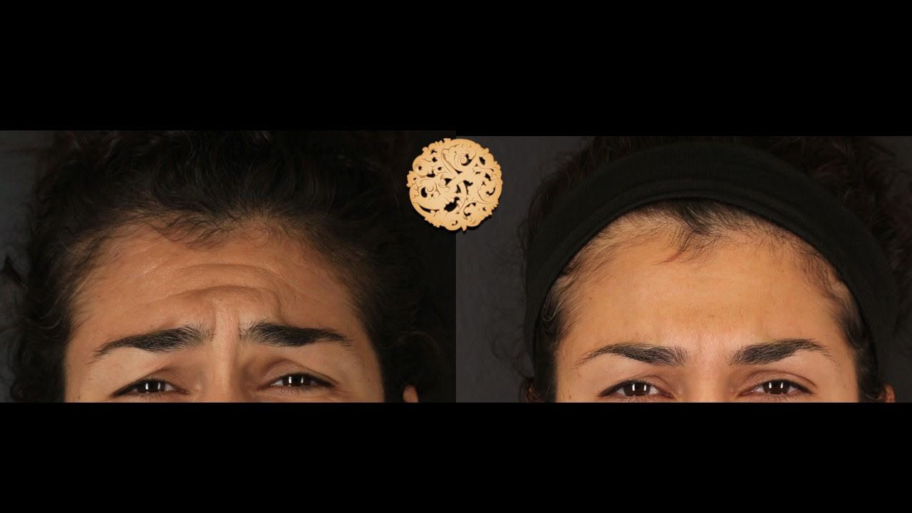 Gold Tip Botox Facial Before & After