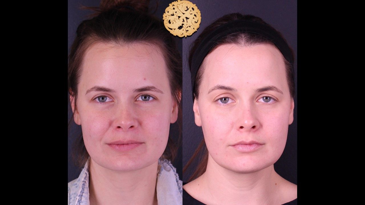Gold Tip Botox Facial Before & After