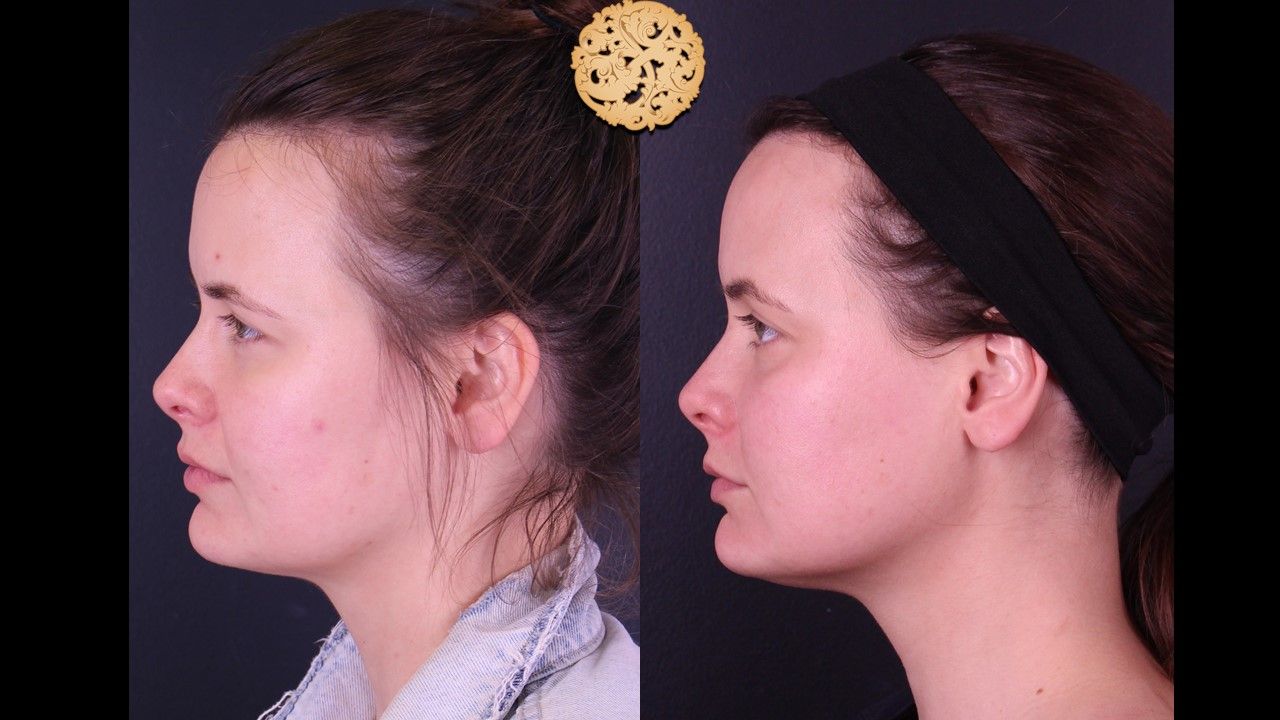 Gold Tip Botox Facial Before & After