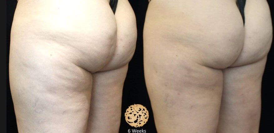 Cellfina Before & After