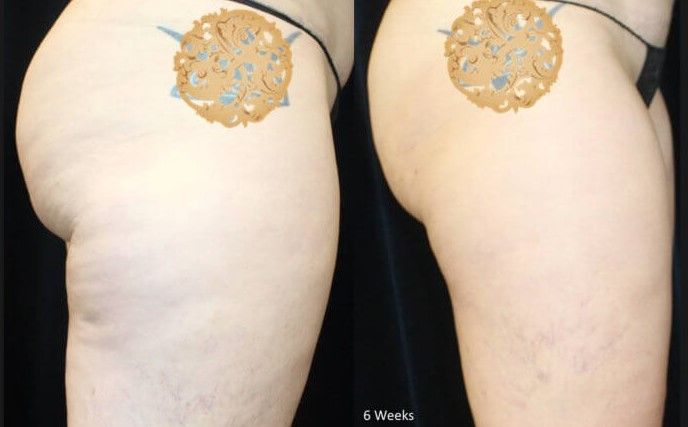 Cellfina Before & After