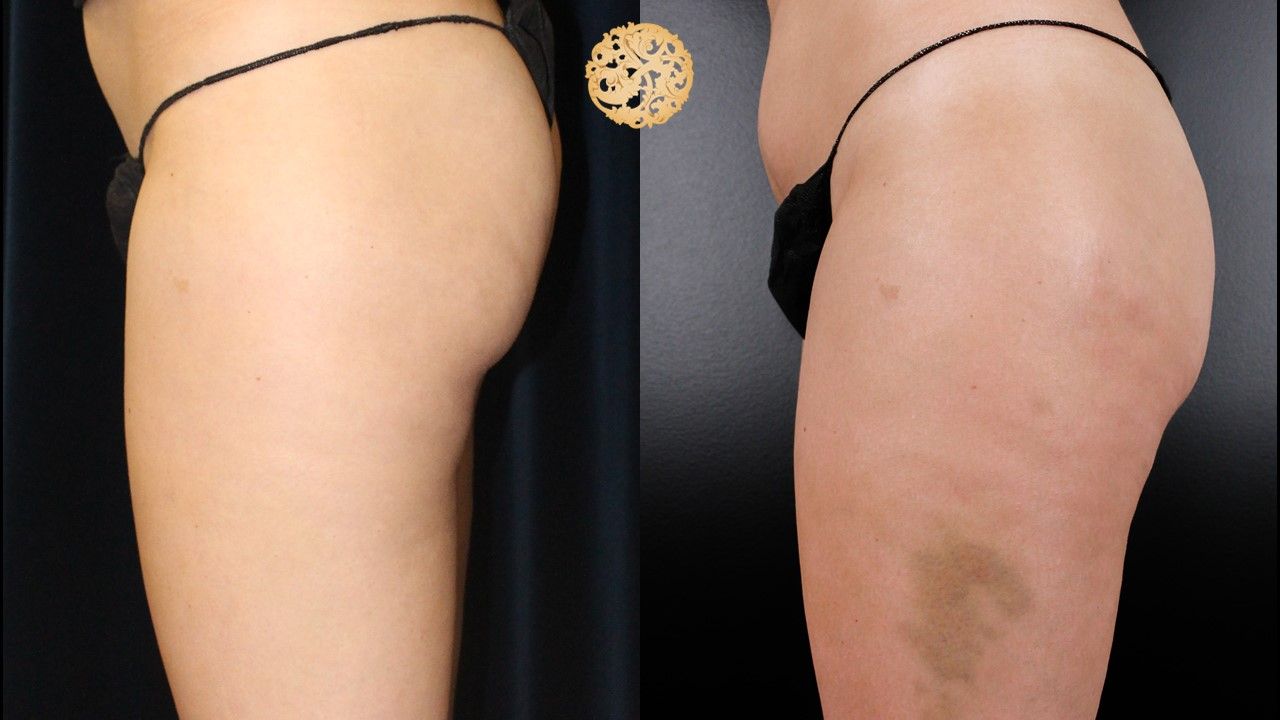 Cellfina Before & After