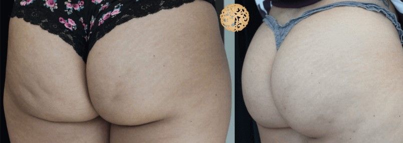 Cellfina Before & After