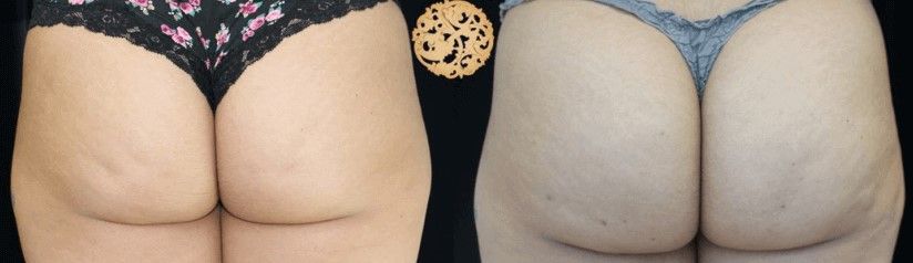 Cellfina Before & After